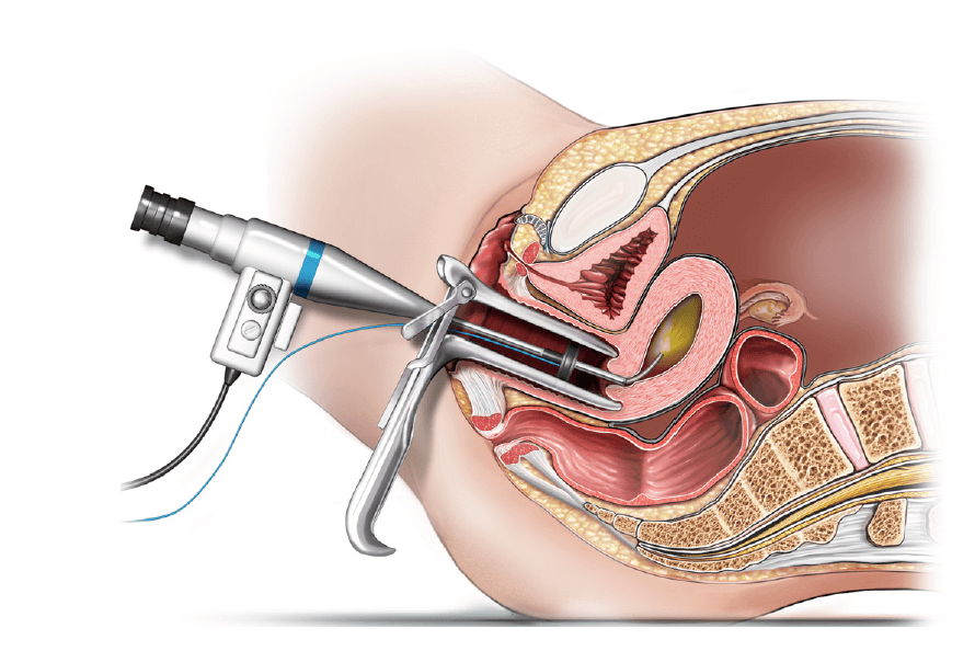 Гистероскопия раздельное выскабливание. Гистероскопия полипэктомия. Гистероскопия с раздельным диагностическим выскабливанием. Гистероскопическая миомэктомия. Трансвагинальная миомэктомия.